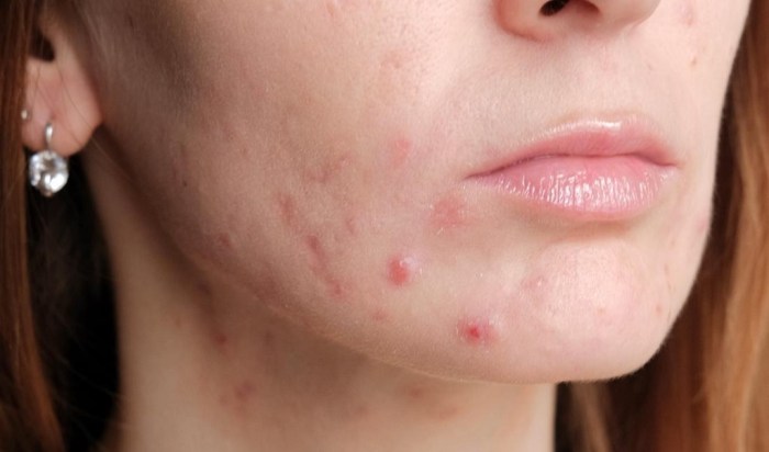 Acne Treatments: Tackling Skin Concerns Worldwide